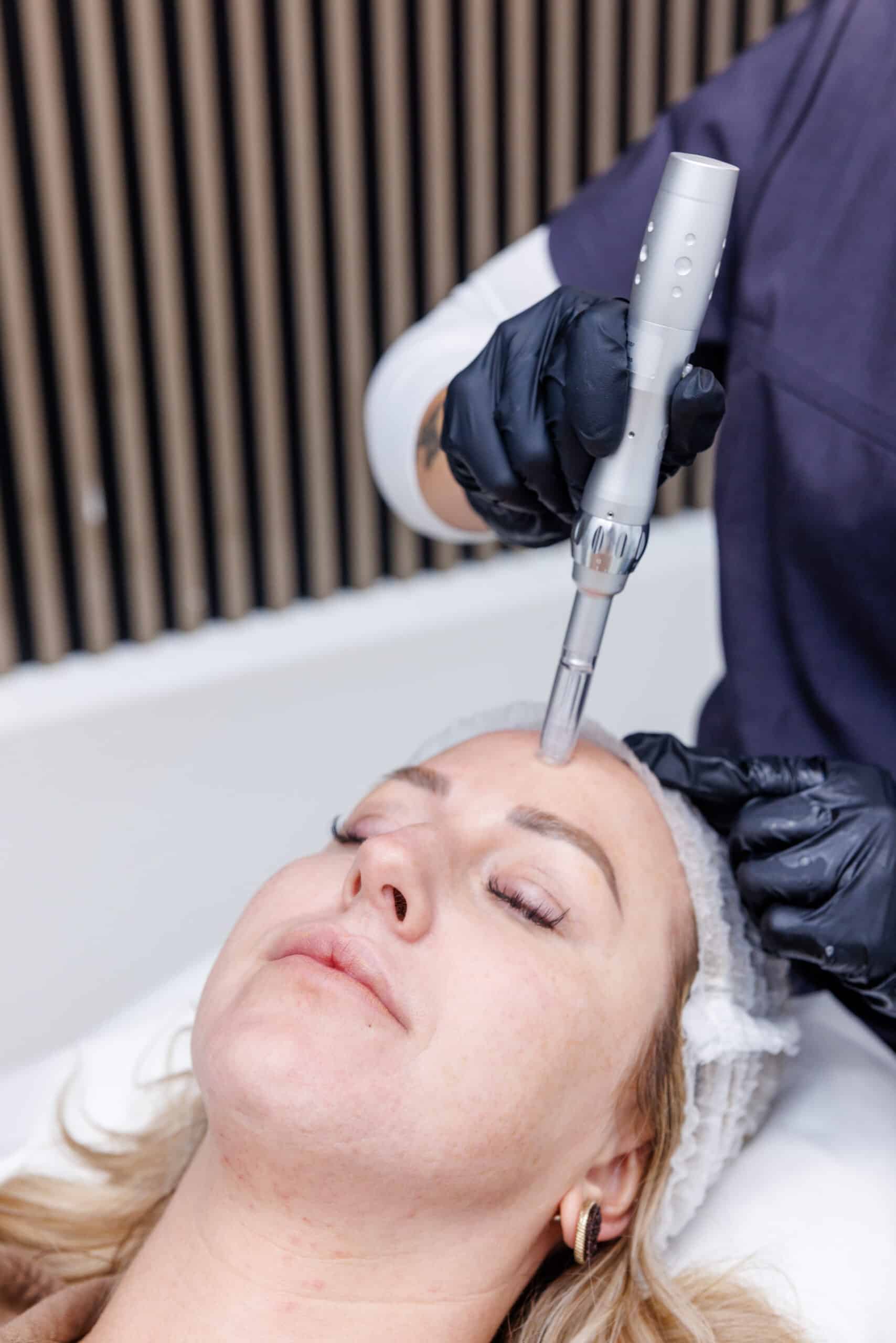 FAQs About Microneedling