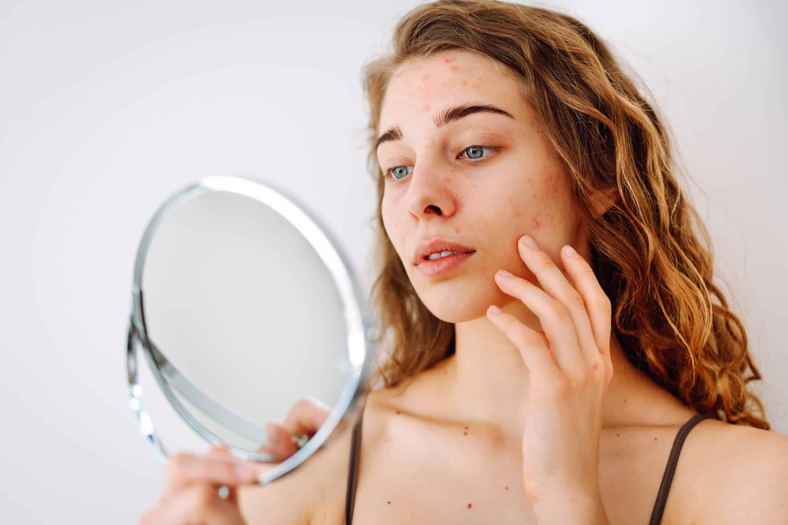 FAQs About Acne