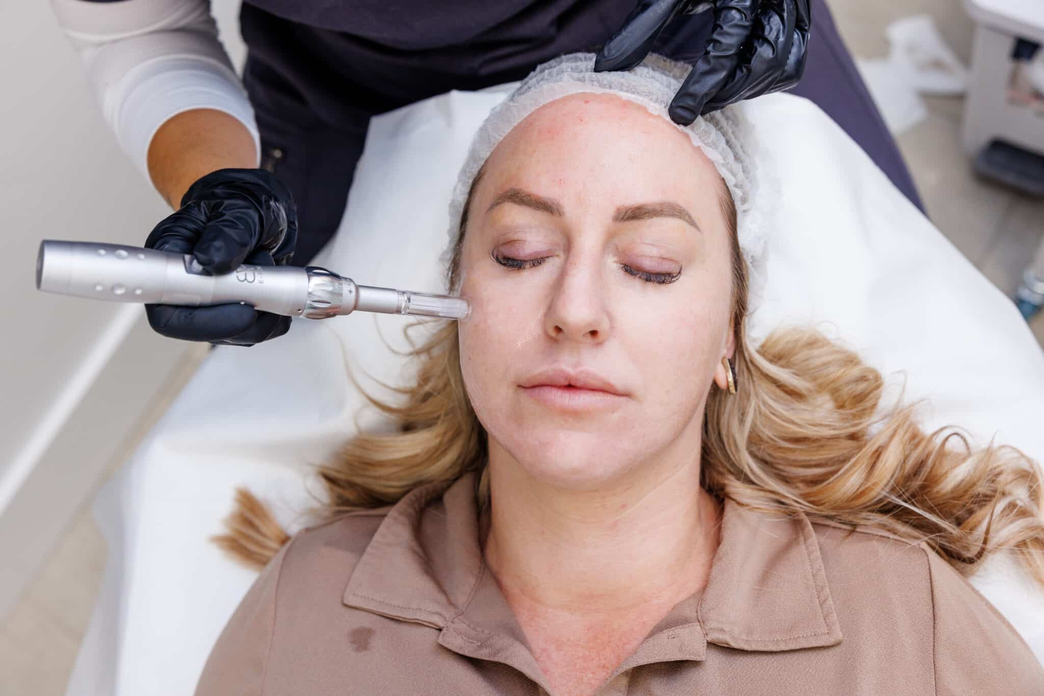 Why Clients Choose Microneedling
