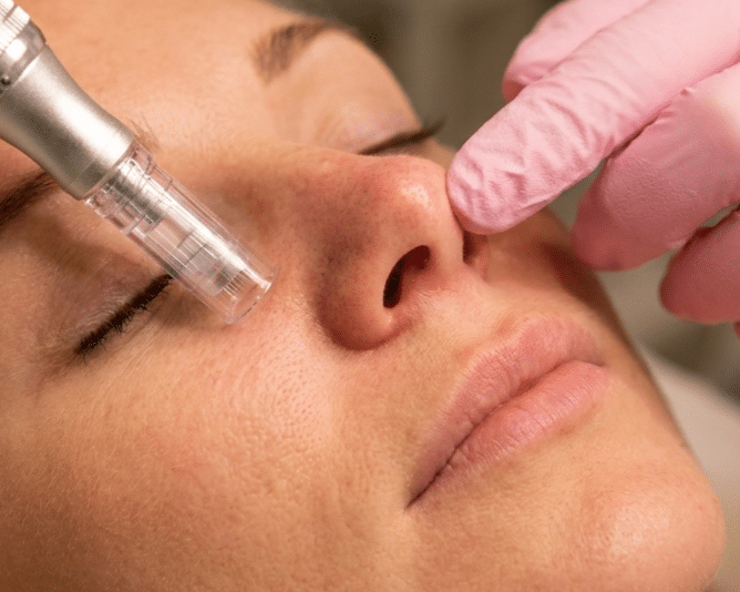 Is Signature Microneedling Right for You?