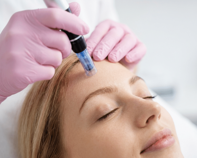 MICRONEEDLING WITH EXOSOMES