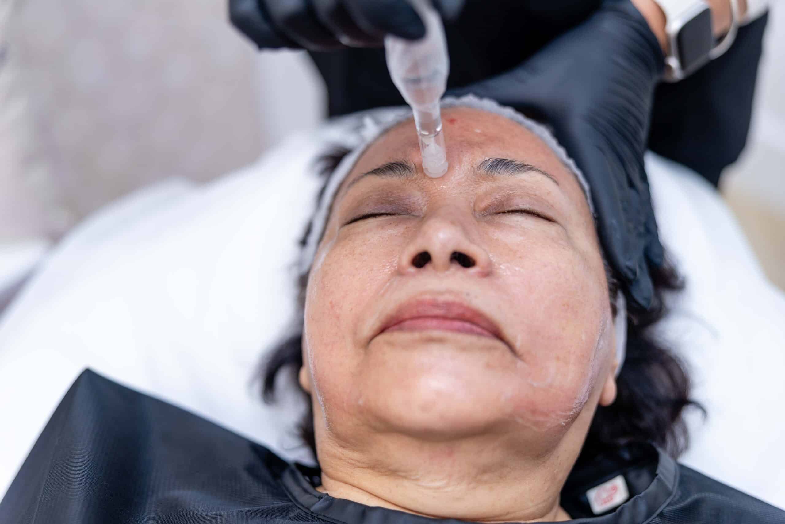 Microneedling