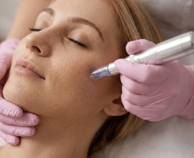 SIGNATURE MICRONEEDLING