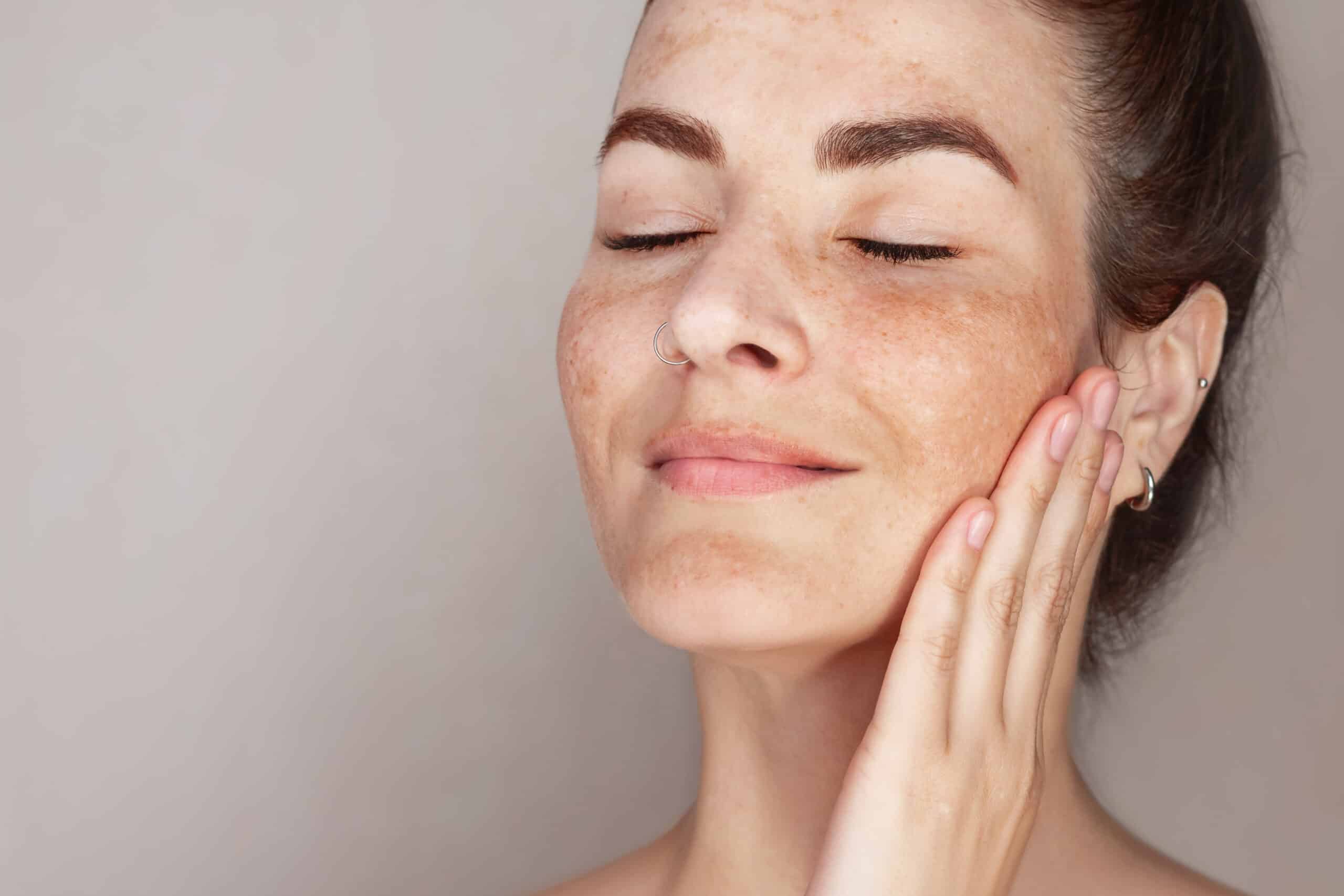 FAQs About Melasma