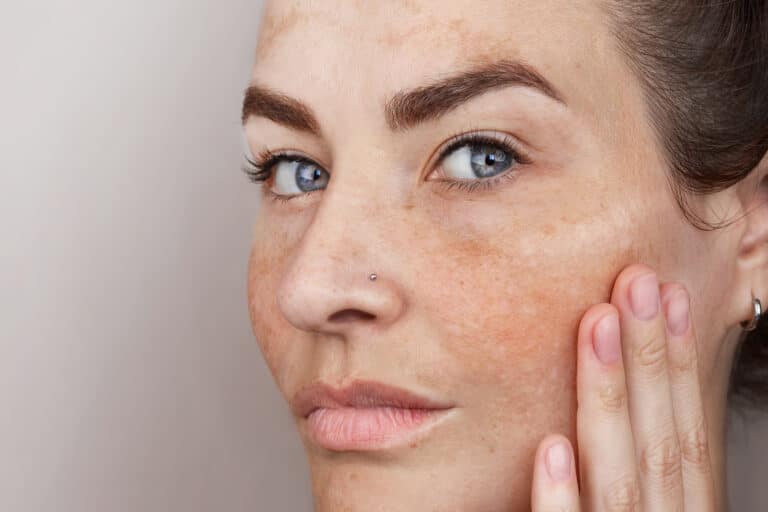 PIGMENTATION
