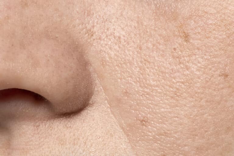 LARGE PORES