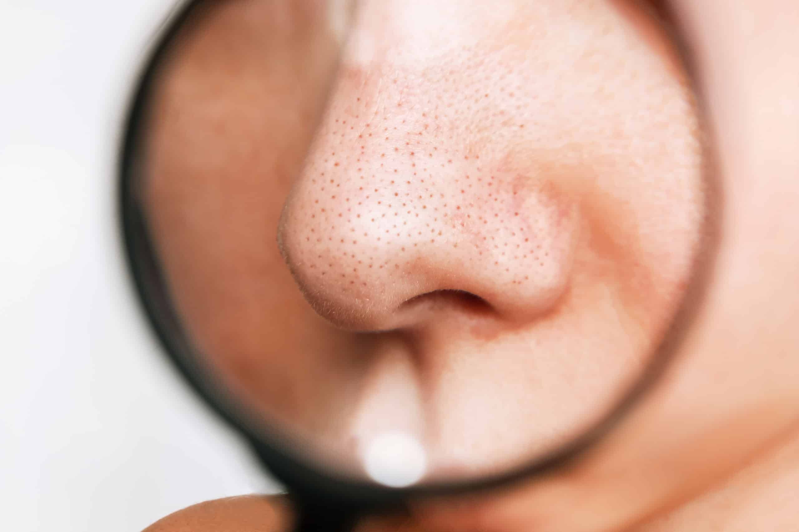 What Causes Large Pores?