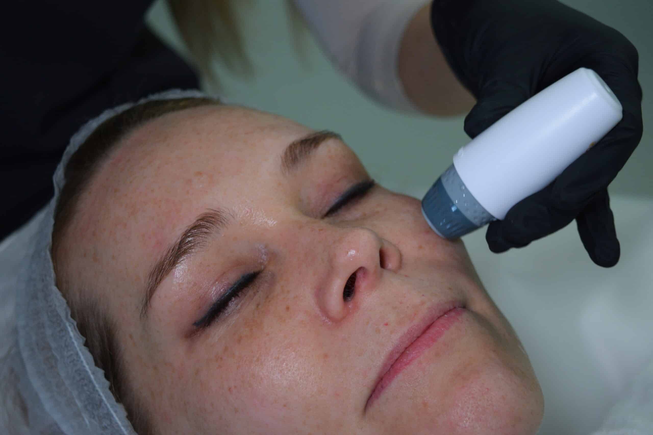 Is Microchanneling with Exosomes Right for You?