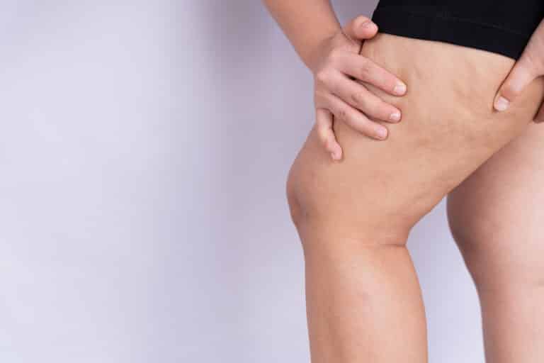 CELLULITE