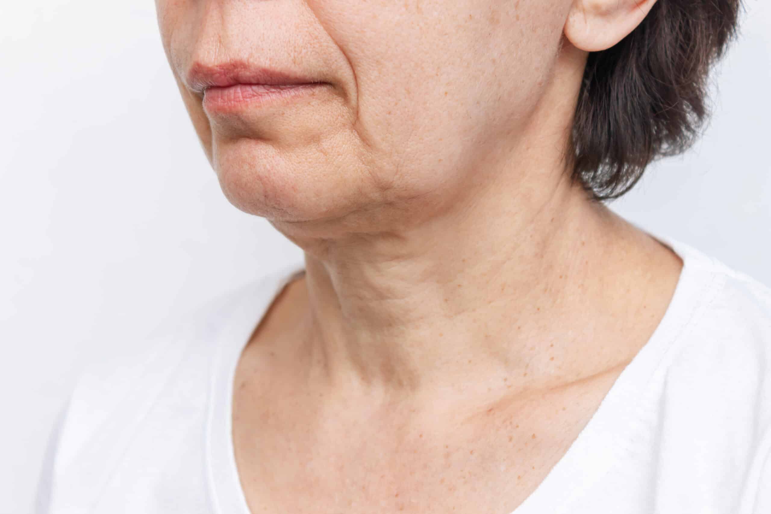 FAQs About Sagging Skin