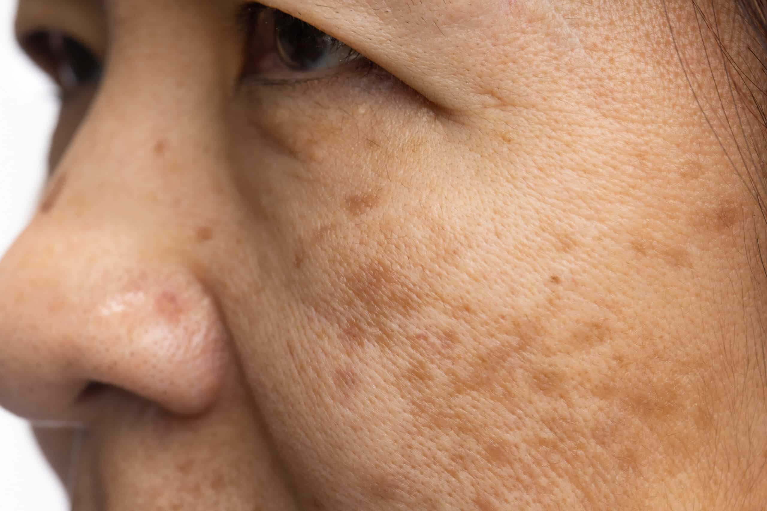 What Causes Pigmentation?
