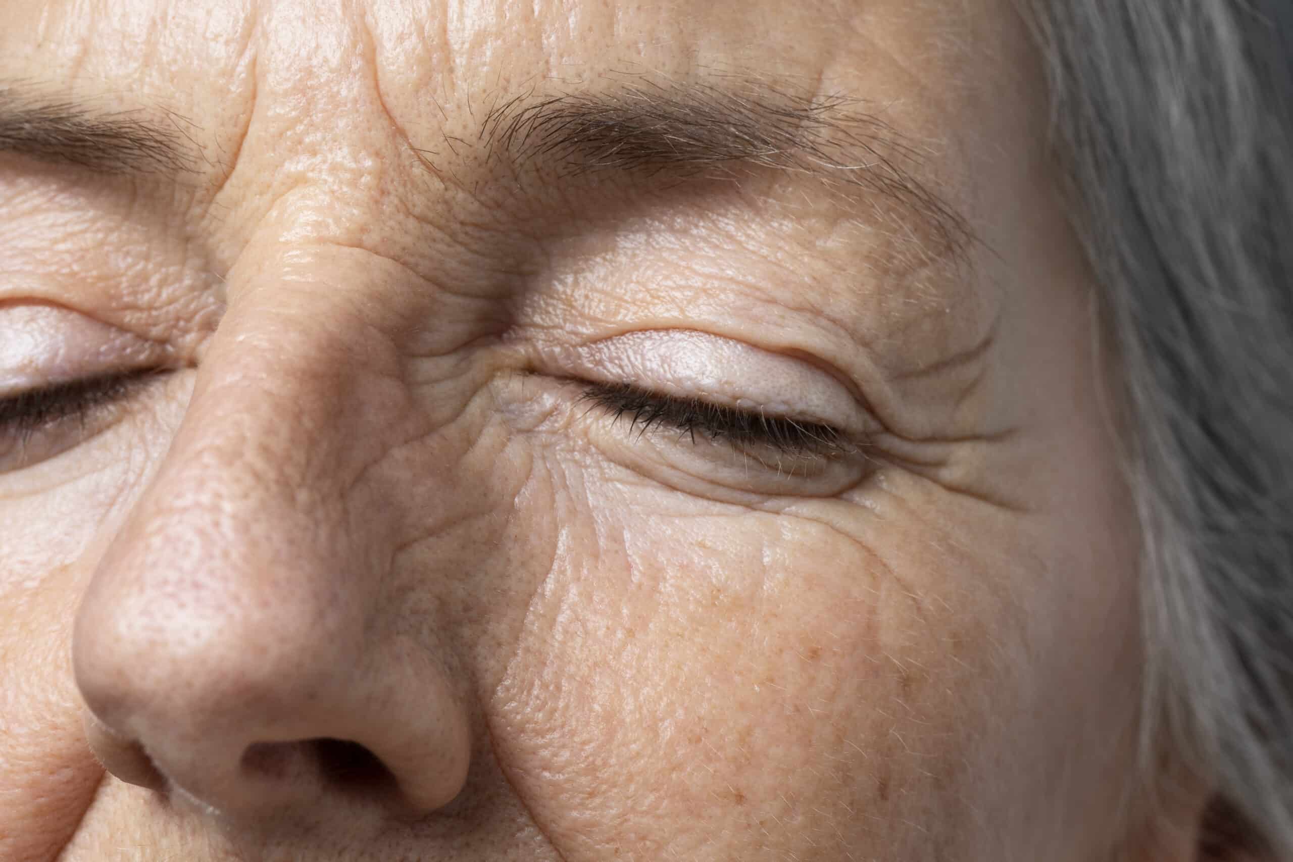 What Causes Wrinkles & Fine Lines?