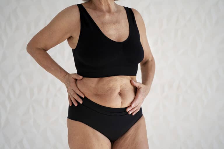 LOOSE SKIN AFTER WEIGHT LOSS