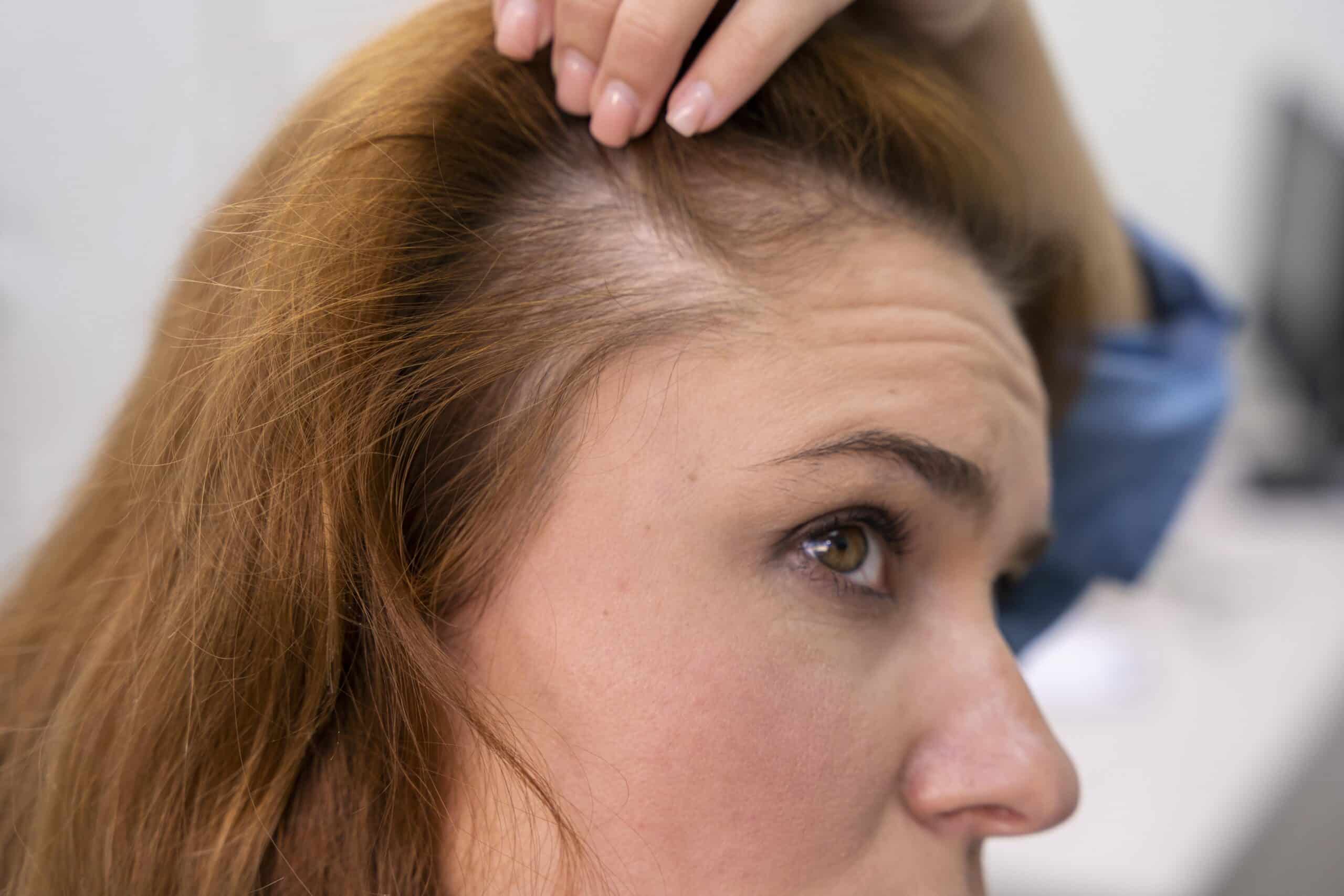 What Causes Hair Loss?