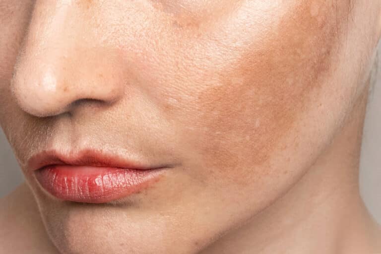 MELASMA