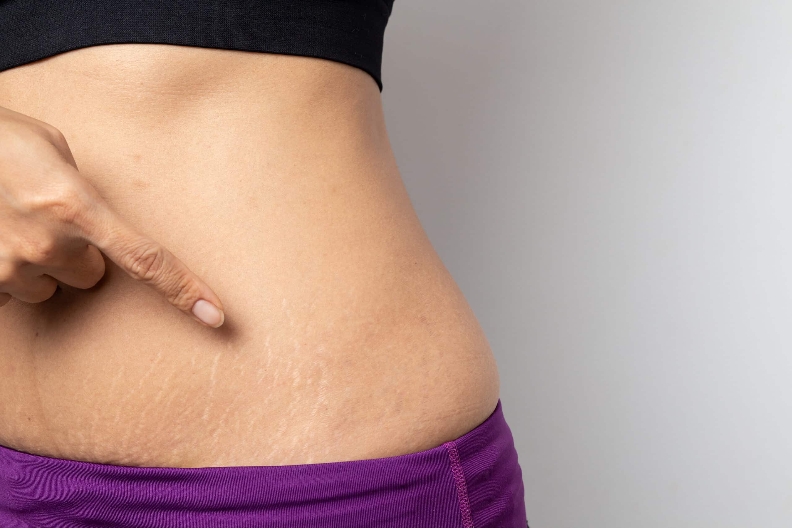 FAQs About Stretch Marks