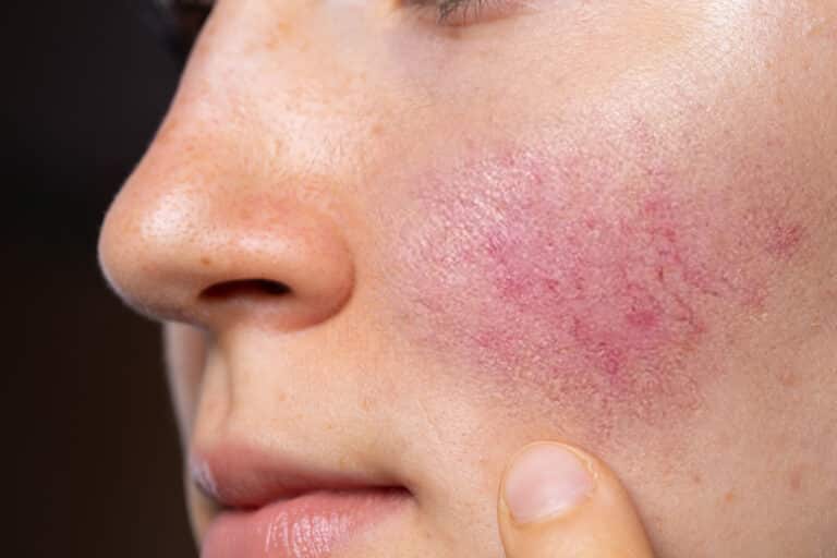 ROSACEA & REDNESS